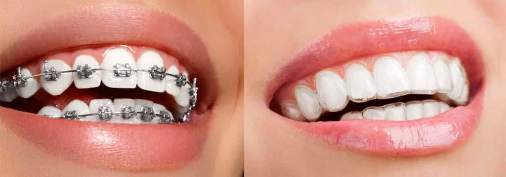 Alinhador Ortodôntico e Estético Blumenau/SC