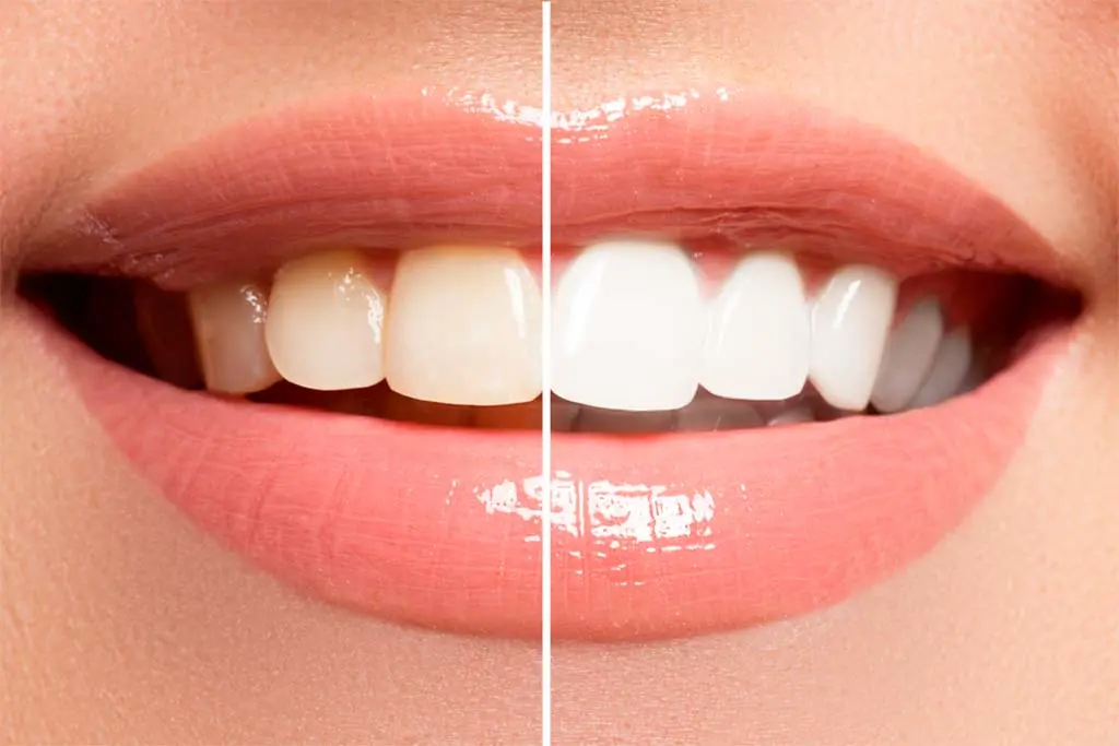 Clareamento Dental Antes e Depois - Blumenau - Clínica cia do Sorriso