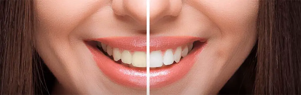 Dentística Estética Clareamento Blumenau - Clínica Cia do Sorriso