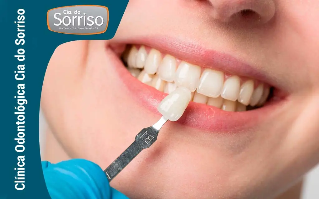 Facetas Dentárias Blumenau/SC