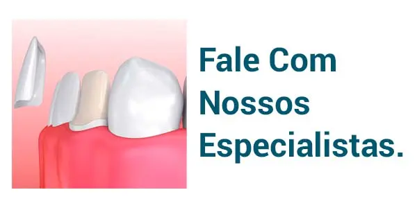 Facetas Dentárias em Blumenau/SC