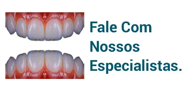 Lentes Dentárias - Blumenau/SC