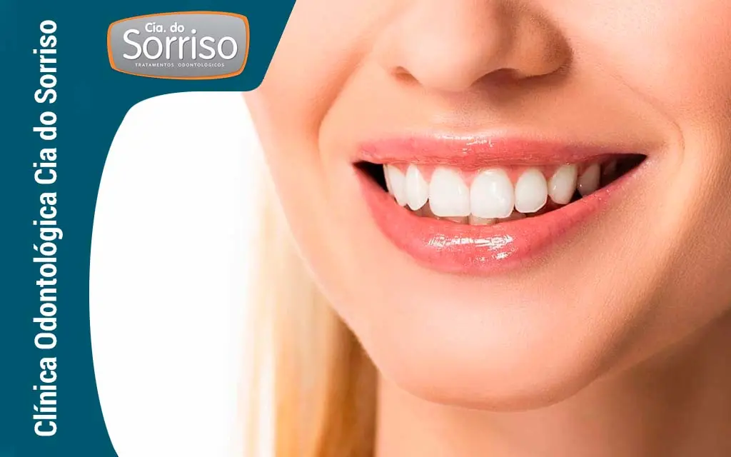 Lentes Dentárias em Blumenau - Clínica Cia do Sorriso