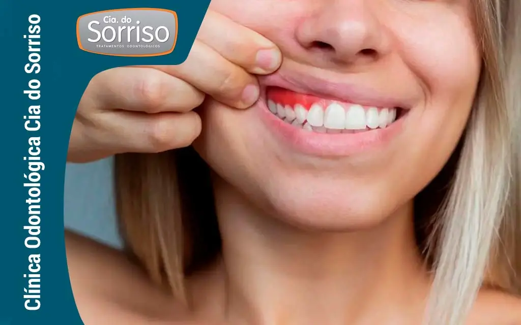 Periodontia - Clínica Cia do Sorriso - Blumenau/SC