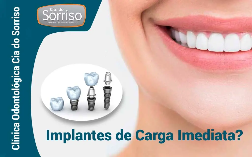 Implante de Carga Imediata em Blumenau? - Clínica Cia do Sorriso