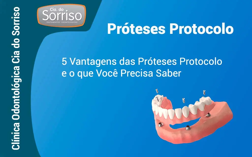 5 Vantagens das Próteses Protocolo e o que Você Precisa Saber