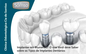 Implantes em Blumenau? O que Você deve Saber sobre os Tipos de Implantes Dentários. - Clínica Odontológica Cia do Sorriso.